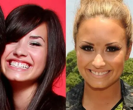 Demi lovato joven diastema Cleardent