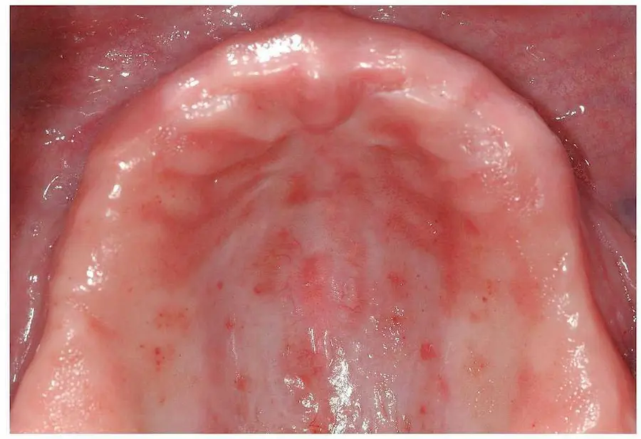 Candidiasis eritematosa