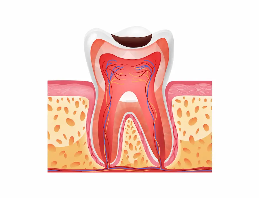 Caries dental dibujo Cleardent 