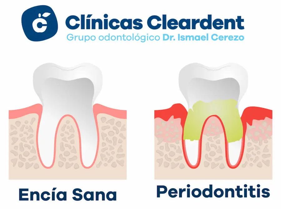 Periodonttis