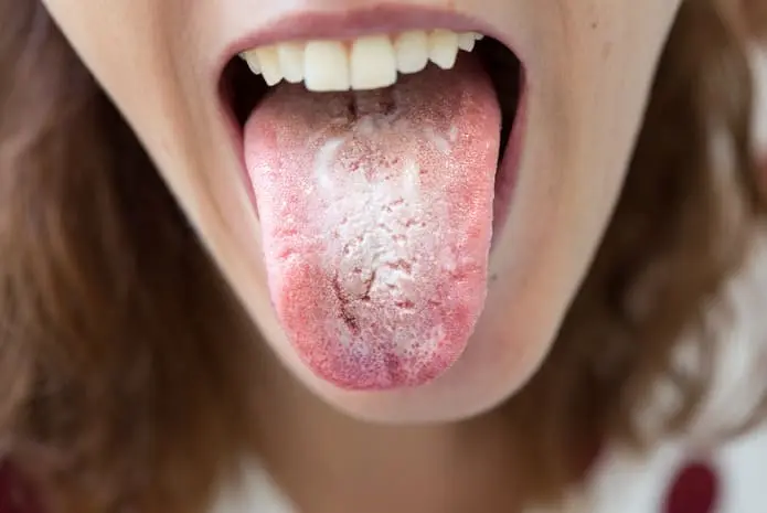 candidiasis oral pseudomembranosa