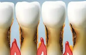 caries radicular 