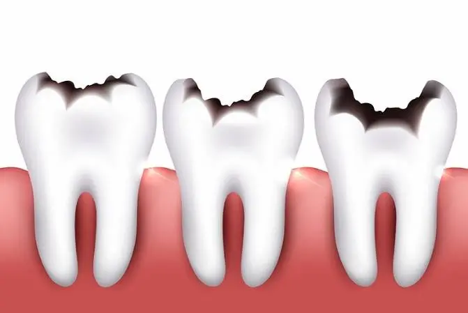 caries de corona