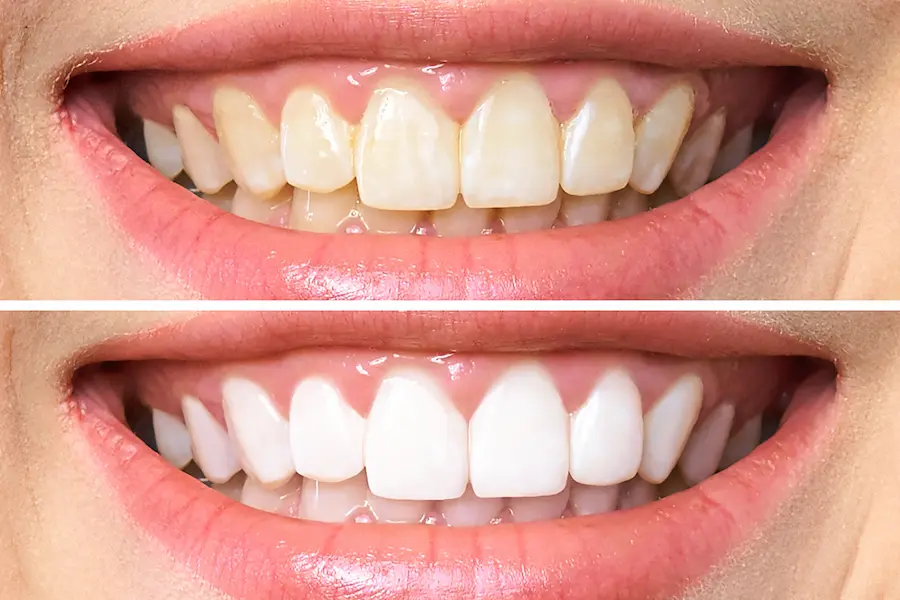 dientes antes después blanqueamiento para la boda