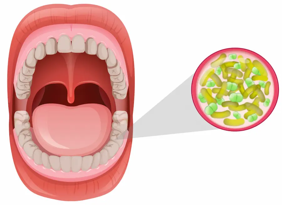 Vistasol Dental - El mal aliento, conocido como #halitosis es un problema  que afecta la seguridad de muchas personas y por ende su relación con los  demás, por ello siempre están en