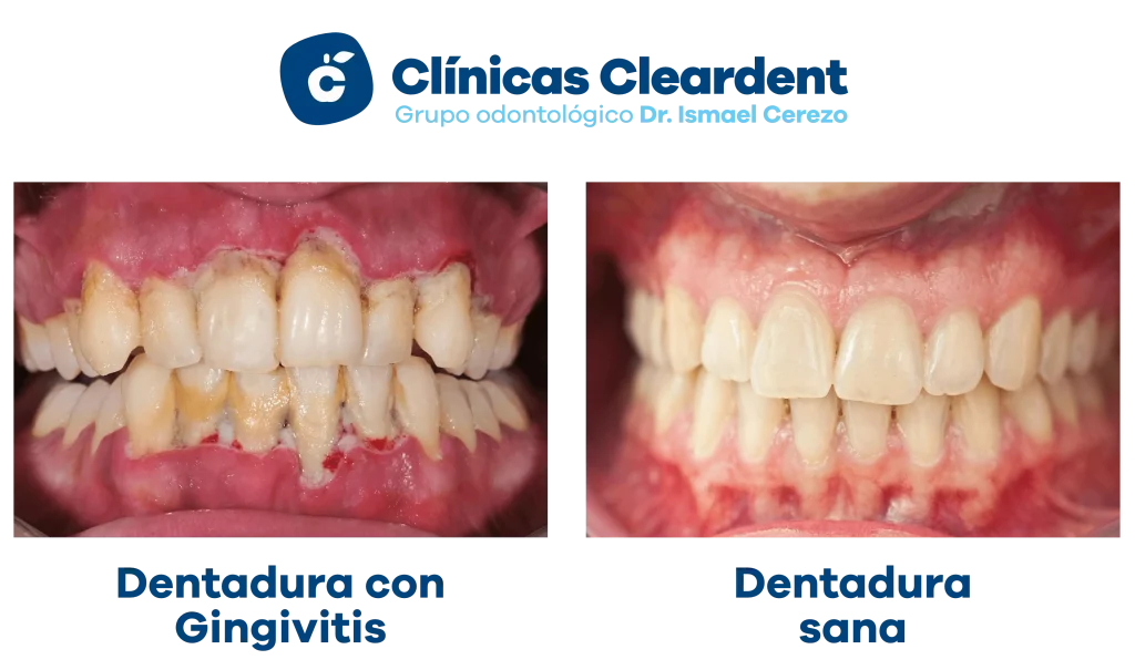 8. Gingivitis antes despues Cleardent