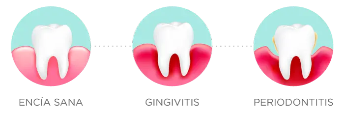 ENF PERIODONTAL FASES