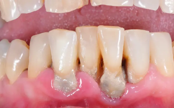 periodontitis avanzada