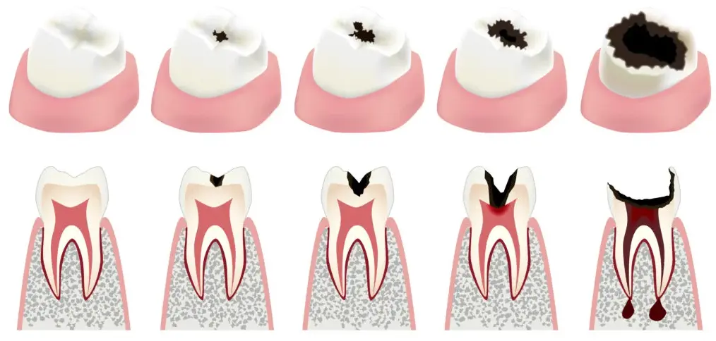 tipos de caries