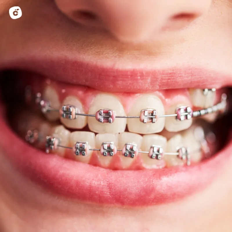 Brackets