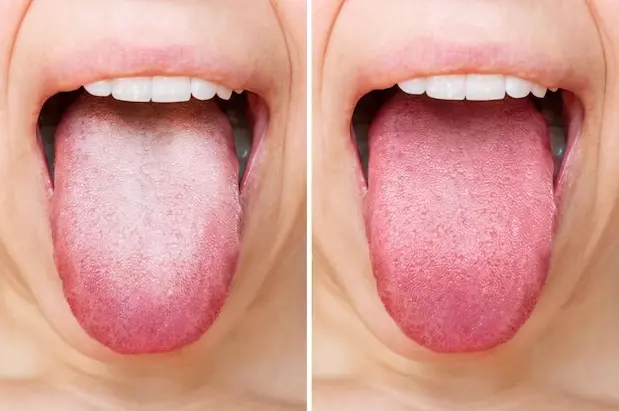 limpieza de lengua antes y despues