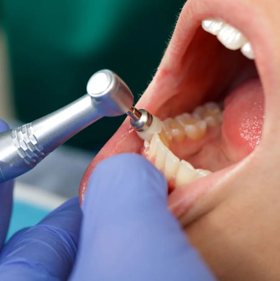 limpieza dental profunda en clínica