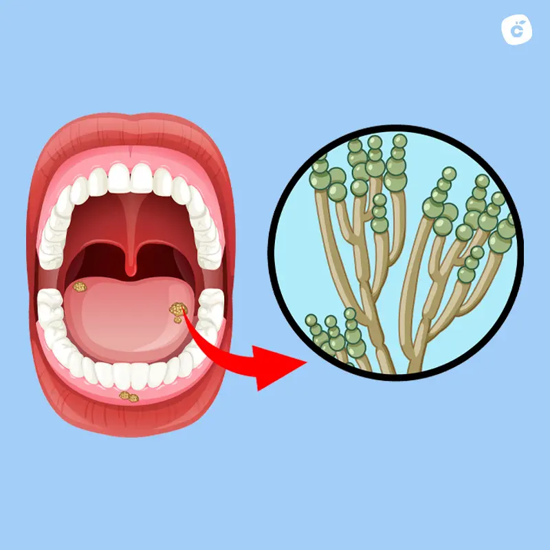 Candidiasis oral, hongos