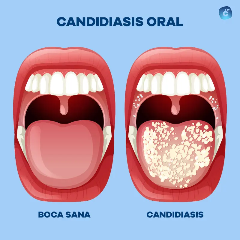 Candidiasis oral