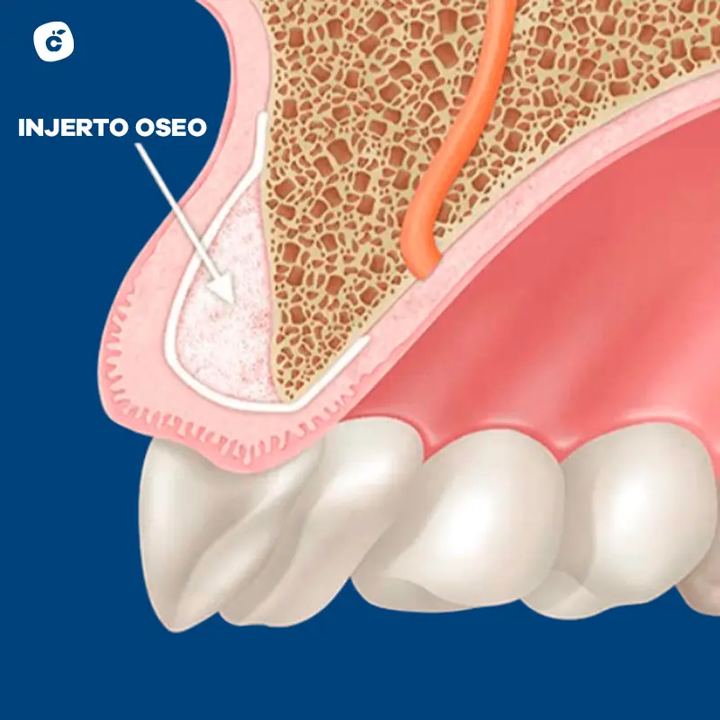 Injerto oseo