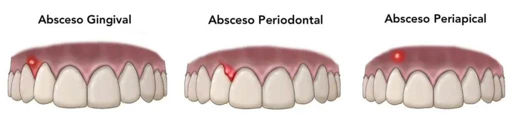 Tipos de abcesos