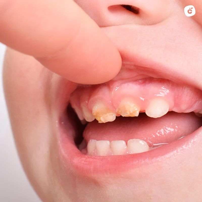 Pérdida prematura de dientes de leche