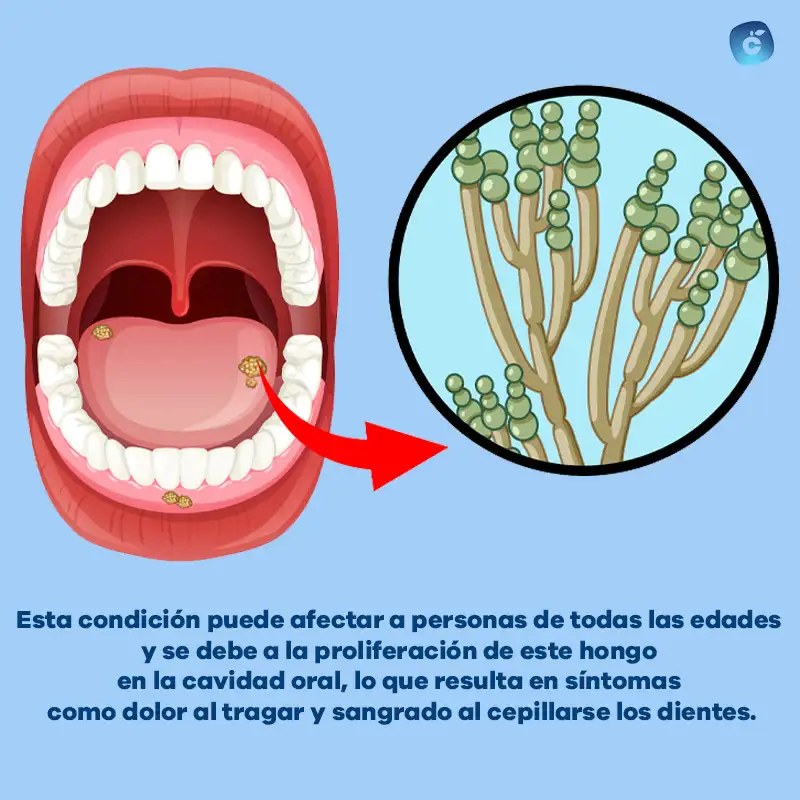 Qué es la candidiasis bucal