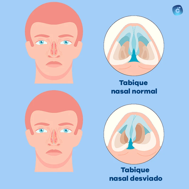 tabique nasal desviado