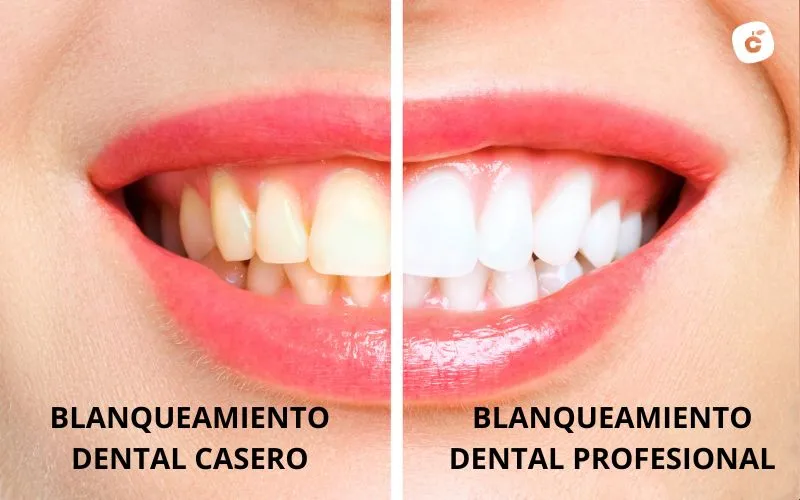 Comparación entre blanqueamiento casero y profesional