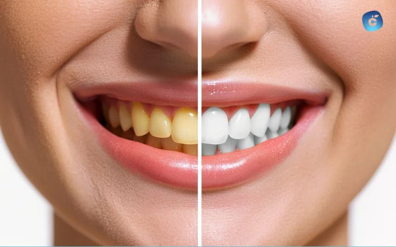 Soluciones para dientes con tetraciclina