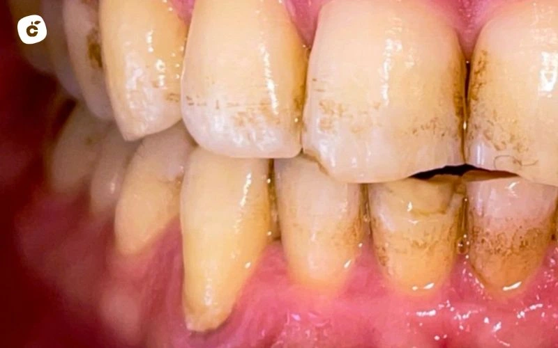 ¿qué es la hipoplasia dental