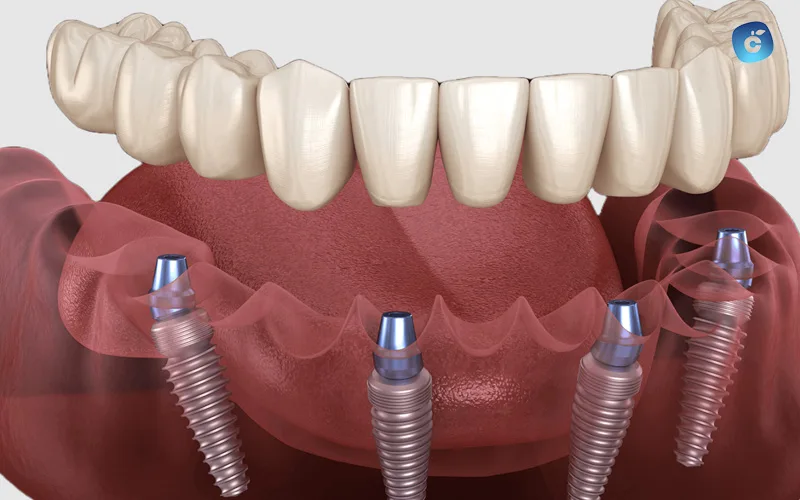 mitos y verdades sobre los implantes dentales