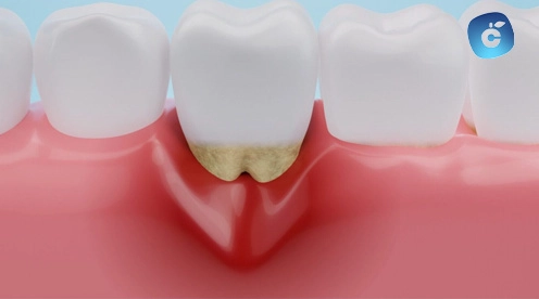 periodontitis en muela