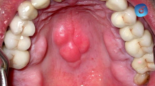 torus mandibular