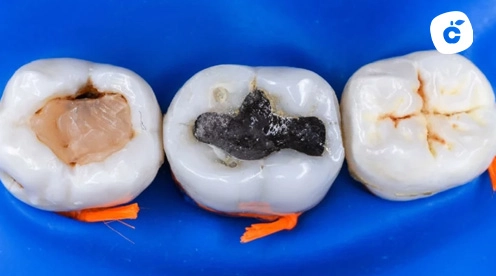 empaste dental antes y despues