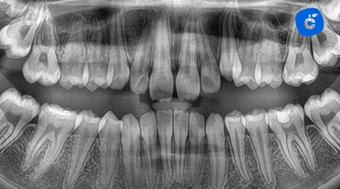 radiografia periapical